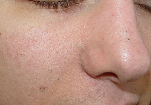 Natural Remedies for Blackheads, Warts and Blemishes