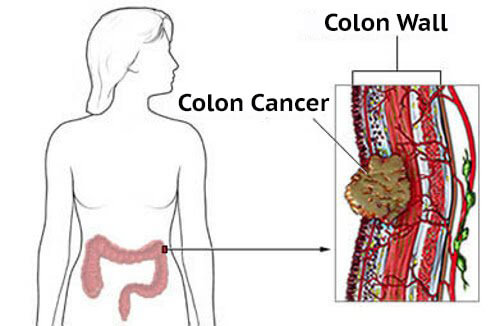 Symptoms of Colon Cancer in Women