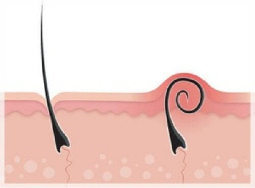 Tips And Tricks On How To Remove Ingrown Hairs