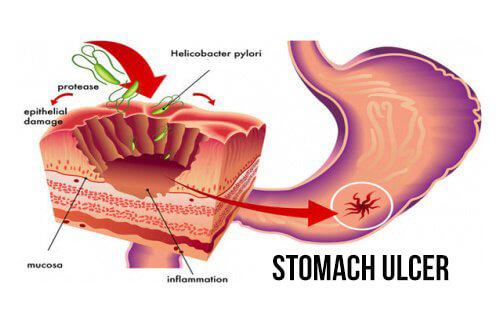 How to Fight Helicobacter Pylori Bacteria