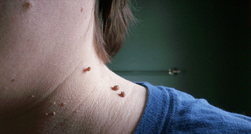 warts