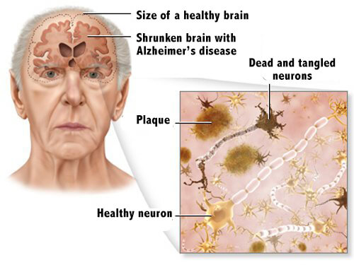 5 Tips For Alzheimer’s Disease Prevention 5 Tips For Alzheimer’s Disease Prevention