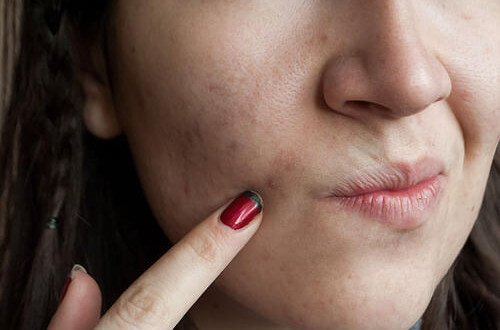 clear-skin 8 Foods for Clear Skin