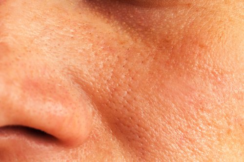Natural Remedies for Enlarged Pores