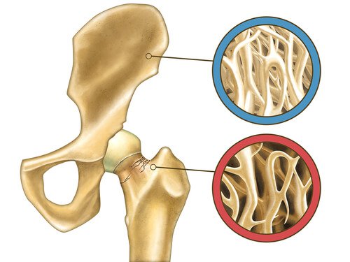 loss-of-bone-mass, bone density