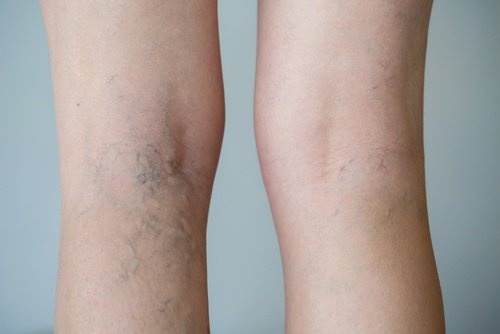 How to Make a Garlic and Lemon Ointment for Varicose Veins