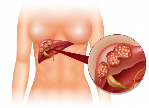 Build up of toxins in the liver