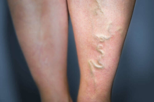 A person with spider veins.
