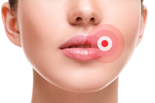 Pain induced by cold sores