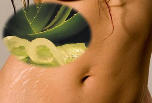 reduce'stretch-marks 6 Natural Remedies to Reduce Stretch Marks