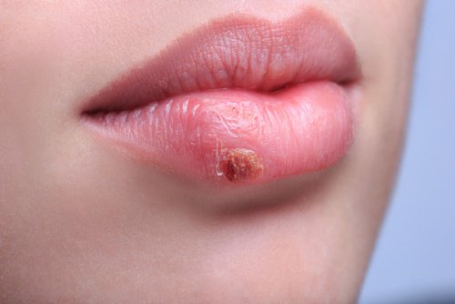 Prevent and Treat Cold Sores Naturally