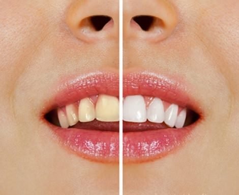 These Foods Cause Yellow Teeth