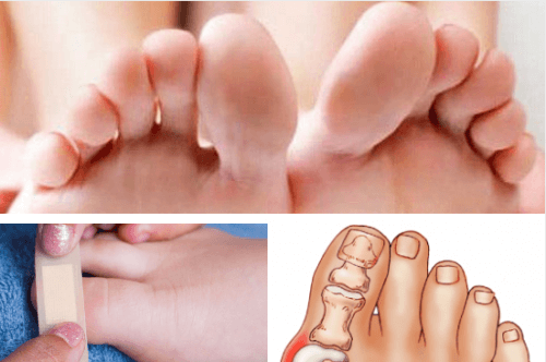Toe Injuries and Illnesses and How to Take Care of Them