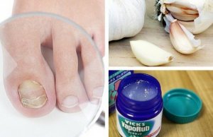 7 Nail Fungus Home Remedies