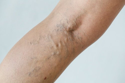 Natural Treatments for Varicose Veins