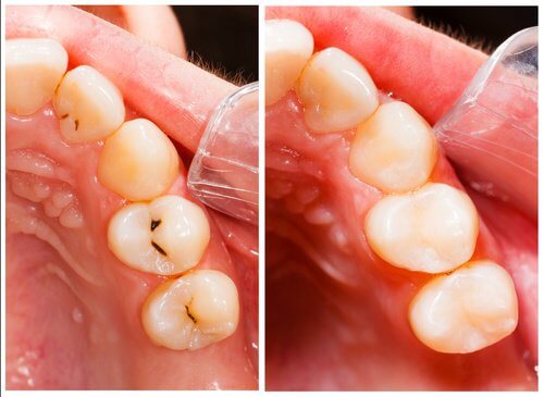 11 Easy Ways to Prevent Tooth Decay