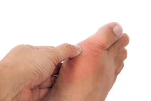Natural Aids for Uric Acid and Gout