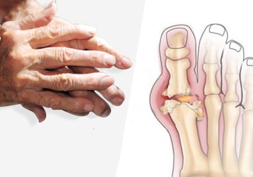 How arthritis affects the joints