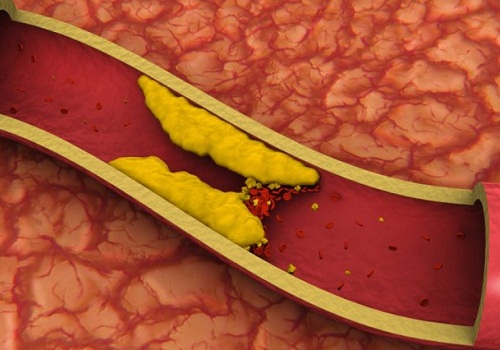 Cholesterol in arteries
