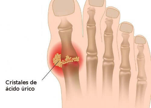 Uric acid crystals in the toe.