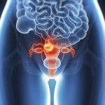 Risks and Symptoms of Endometriosis, a Silent Disease