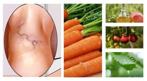 A Three-Ingredient Natural Varicose Vein Treatment