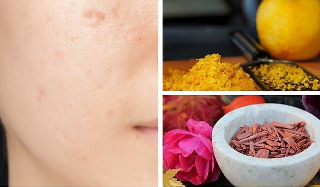 How to Treat Dark Skin Spots How to Treat Dark Skin Spots