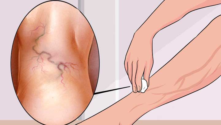 natural varicose vein treatment