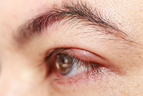 A sty on an eye.