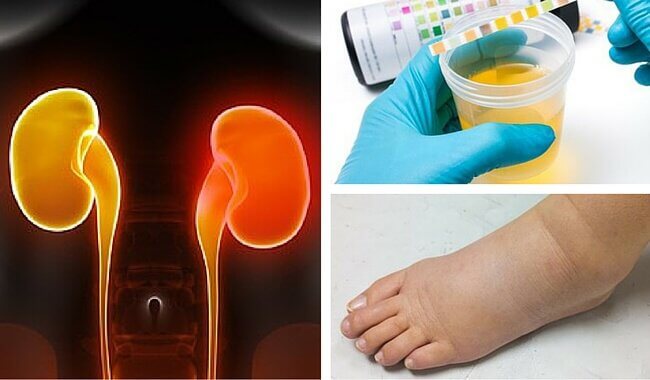 8 Signs of Kidney Failure Most People Ignore