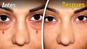 Bags under eyes - five home remedies