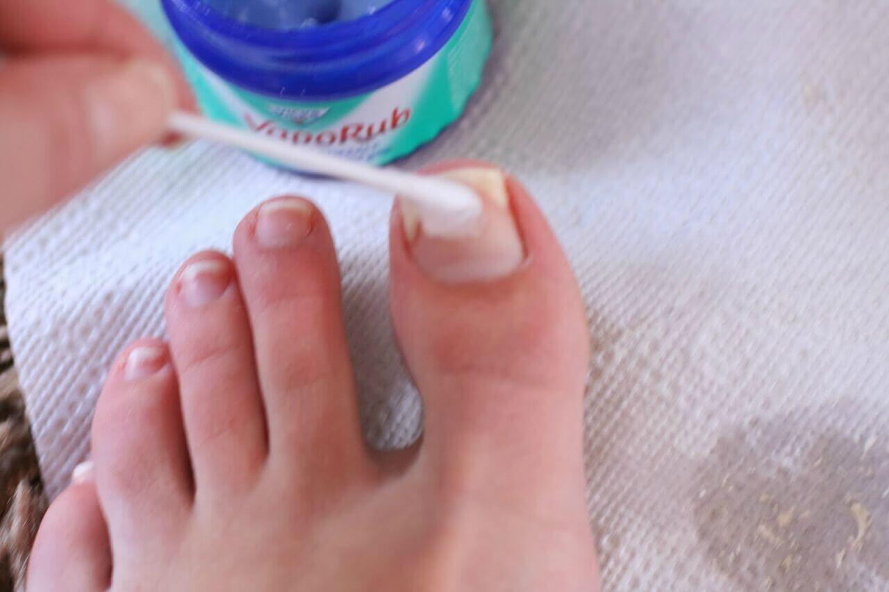 A person applying Vicks VapoRub to their toe.