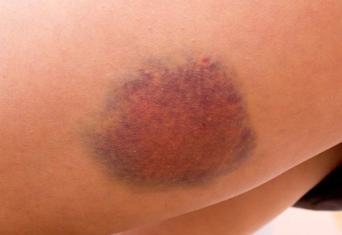 bruises