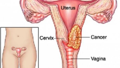 These 7 Factors May Lead To Cervical Cancer