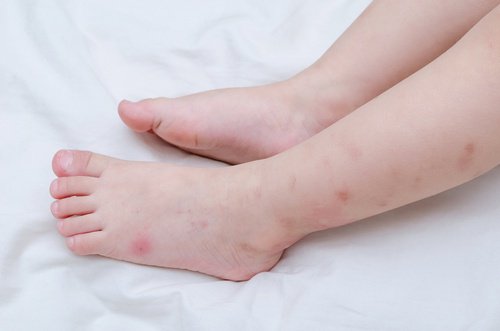 Legs with mosquito bites all over them very red and swollen