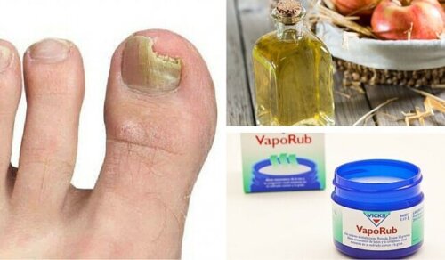 11 Natural Remedies to Get Rid of Nail Fungus