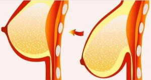 8 Tips and Treatments for Sagging Breasts