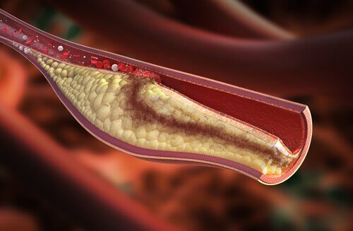 What Are Some Possible Telling Symptoms of High Cholesterol?