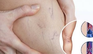 Remedies against Varicose Veins
