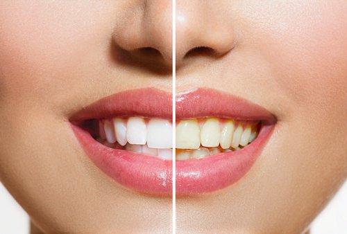 banana peel to whiten teeth