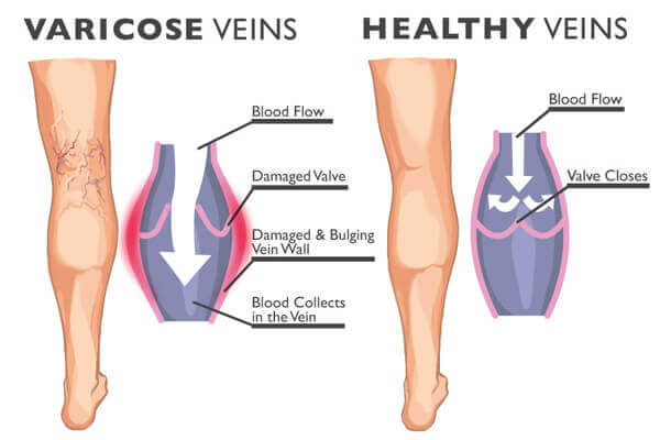 unhealthy veins compared to healthy veins