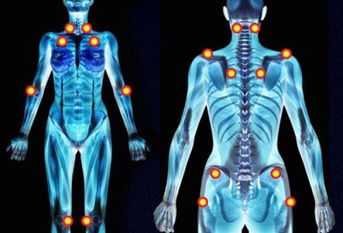 5 Early Warning Signs of Fibromyalgia