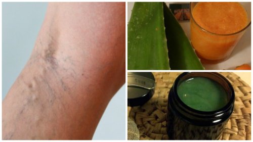 Your Grandmother’s Treatment for Varicose Veins