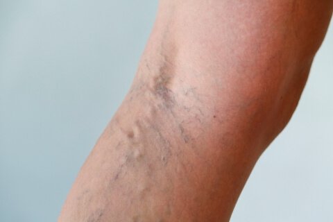 varicose-veins