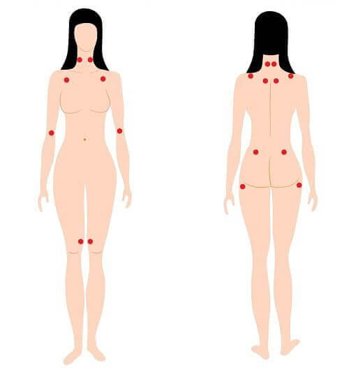 Points of pain in woman with early warning signs of fibromyalgia