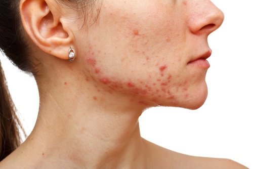 Jaw acne