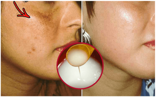 Lighten Skin Naturally with This DIY Cream