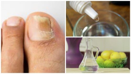 Make your Own Natural Anti-Fungal Treatment for Nails