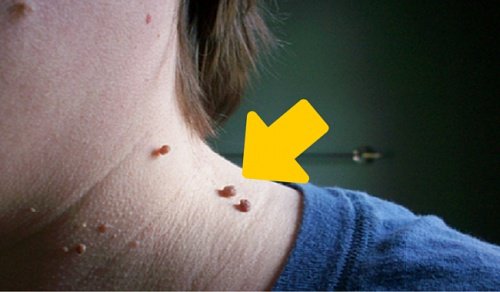 6 Ways to Eliminate Skin Tags Naturally