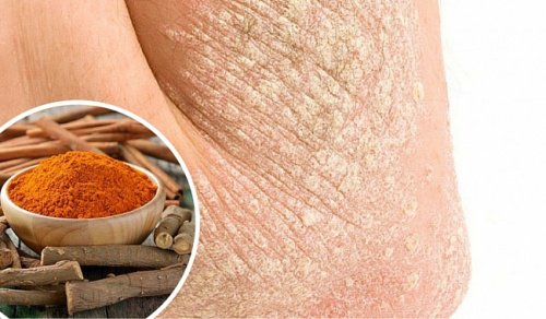 7 Natural Ways to Fight Psoriasis